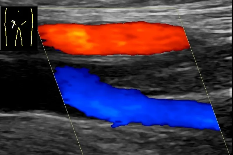 Ultrasonography of deep vein thrombosis of the femoral vein.jpg — Mikael Häggström et al. (CC0)